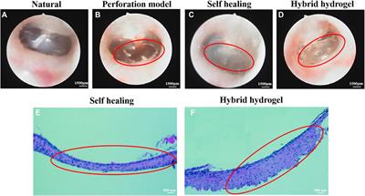 Hybrid Hydrogel Composed of Hyaluronic Acid, Gelatin, and Extracellular Cartilage Matrix for Perforated TM Repair